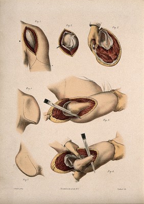 Excision of the shoulder joint (?) Coloured lithograph by M. Hanhart after C. Heath after J.B. Léveillé.