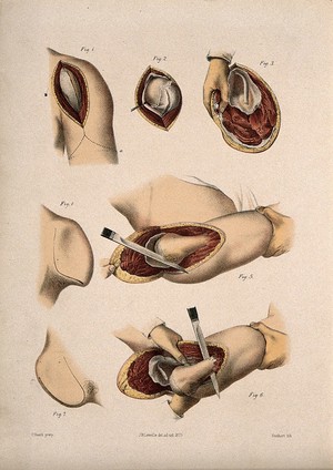 view Excision of the shoulder joint (?) Coloured lithograph by M. Hanhart after C. Heath after J.B. Léveillé.