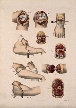 view Cross-sections of the arm and wrist. Coloured lithograph by M. Hanhart after C. Heath after J.B. Léveillé.