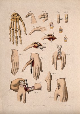 Cross-sections of hands and fingers and amputations of fingers. Coloured lithograph by M. Hanhart after C. Heath after J.B. Léveillé.