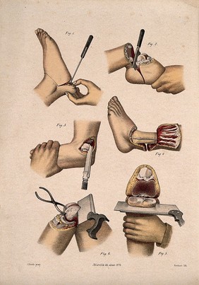 Surgical operations on the foot, ankle and knee: six figures. Coloured lithograph by M. Hanhart after C. Heath after J.B. Léveillé.