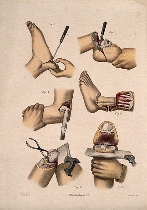 view Surgical operations on the foot, ankle and knee: six figures. Coloured lithograph by M. Hanhart after C. Heath after J.B. Léveillé.