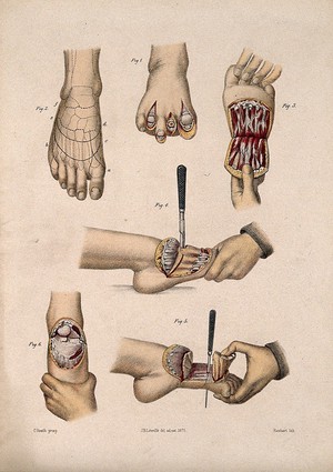 view Six cross-sections through a foot. Coloured lithograph by M. Hanhart after C. Heath after J.B. Léveillé.