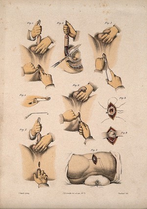 view Nine cross-sections through the male reproductive organs, urinary system and anus. Coloured lithograph by M. Hanhart after C. Heath after J.B. Léveillé.