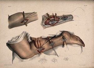 view An operation being performed on a leg and ankle. Coloured lithograph by N.H. Jacob after himself.