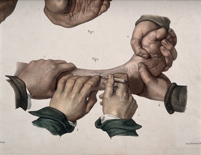 Clubfoot and the operation to cure the condition. Coloured lithograph by N.H. Jacob.