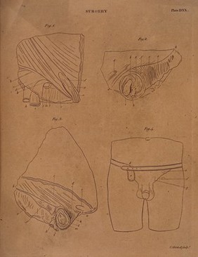 Four diagrams illustrating cross-sections of the male reproductive organs. Etching by E. Mitchell.