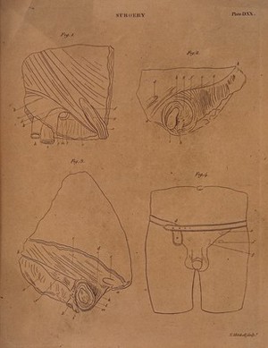 view Four diagrams illustrating cross-sections of the male reproductive organs. Etching by E. Mitchell.