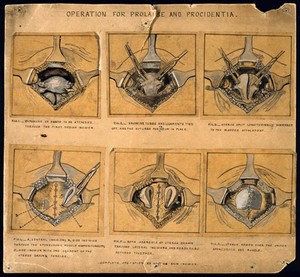 view Six diagrams illustrating an operation for a prolapsed uterus or procidentia. Pen drawing.