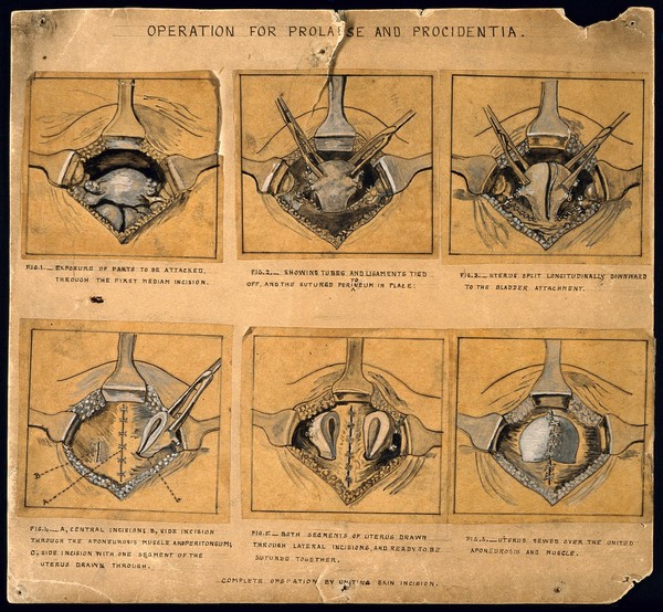 Six diagrams illustrating an operation for a prolapsed uterus or procidentia. Pen drawing.