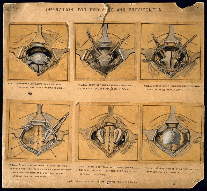 Six diagrams illustrating an operation for a prolapsed uterus or