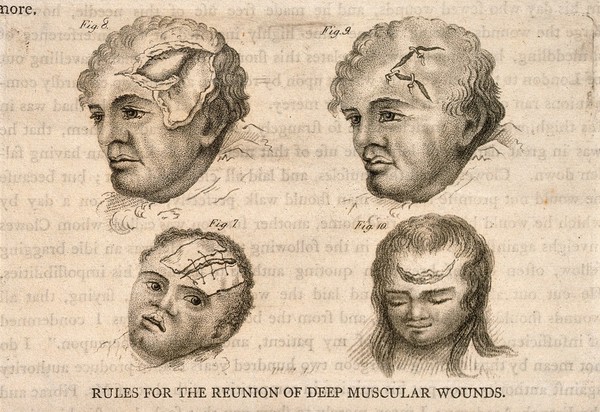 Four diagrams illustrating heads with severe wounds, demonstrating how to stitch the skin back together properly. Stipple engraving by J. Bell.