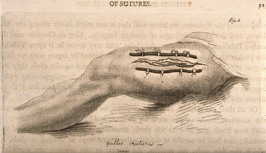 A wounded leg with a quilled suture. Stipple engraving by J. Bell.