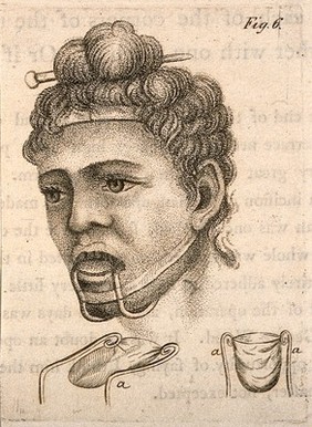 A diagram of a head illustrating a jaw and chin brace. Stipple print by J. Bell.