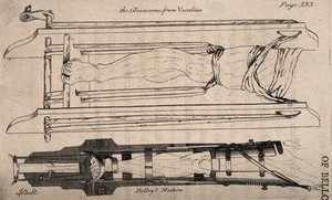 view Two diagrams comparing two sets of apparatus for the leg designed by Vesalius and Belloq. Etching by J. Bell.