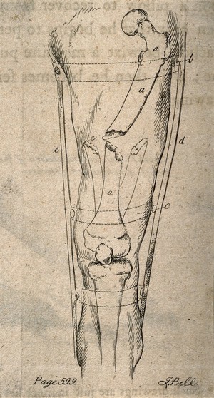 view A diagram illustrating an apparatus to bind together a broken leg. Etching by J. Bell.