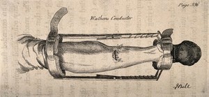 view A piece of apparatus designed by J. Wathen to bind together a broken leg. Etching by J. Bell.