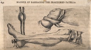 view Methods of bandaging a fractured patella. Etching by J. Bell.