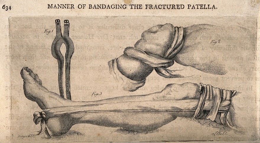Methods of bandaging a fractured patella. Etching by J. Bell.