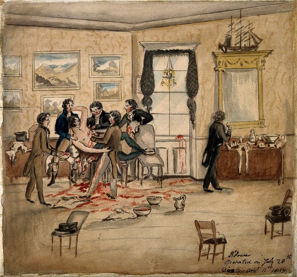 A surgical operation to remove a malignant tumour from a man's left breast and armpit in a Dublin drawing room, 1817. Watercolour, ca 1913, after a watercolour, 1817.