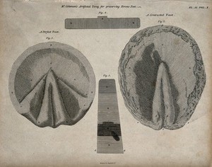 view Horses' hooves, seen from below: four figures showing both perfect and contracted feet, demonstrating Mr. Coleman's 'artificial frog' for the preservation of horses' hooves. Etching by J. Barlow, 1802.