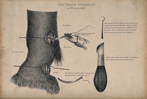 Nerve operation on an animal (a horse?): four figures, including illustrations of instruments used in the operation. Etching, 1840/1870?
