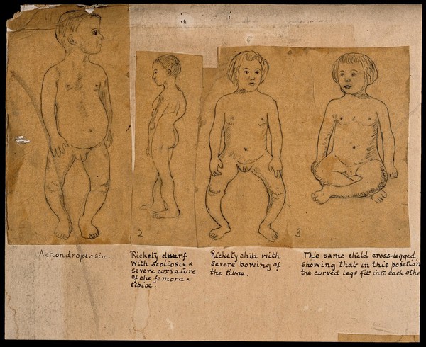 Children with orthopedic disorders. Twenty six pen drawings.