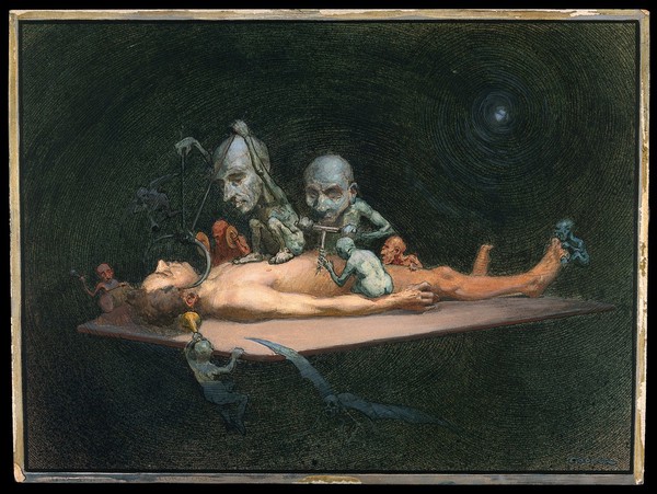 An unconscious naked man lying on a table being attacked by little demons armed with surgical instruments; representing the effects of chloroform on the human body. Watercolour by R. Cooper.