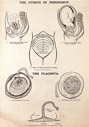 view The uterus in pregnancy, and the placenta. Lithograph after W. F. Victor Bonney.