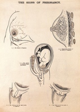 The signs of pregnancy. Lithograph after W. F. Victor Bonney.