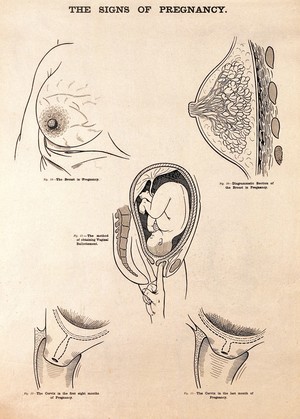 view The signs of pregnancy. Lithograph after W. F. Victor Bonney.