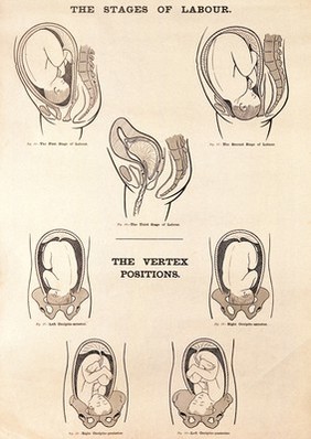 The stages of labour and the vertex positions. Lithograph after W. F. Victor Bonney.