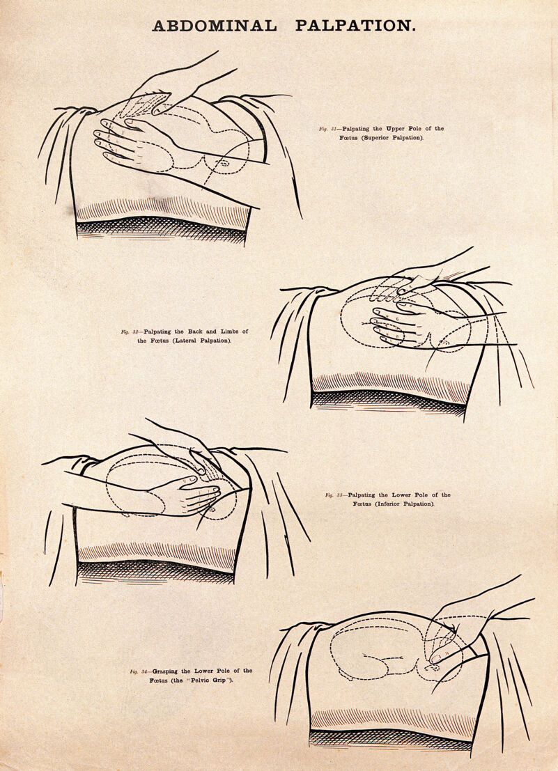 abdominal-palpation-in-pregnancy-lithograph-after-w-f-victor-bonney