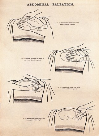 Abdominal palpation in pregnancy. Lithograph after W. F. Victor Bonney.