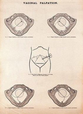 Vaginal palpation in pregnancy. Lithograph after W. F. Victor Bonney.