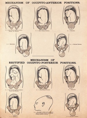 view Mechanisms of occipito-anterior positions and rectified occipito-posterior positions of the foetus. Lithograph after W. F. Victor Bonney.