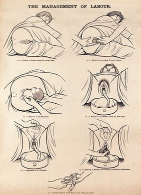 The management of labour. Lithograph after W. F. Victor Bonney.