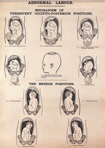 Mechanism of persistent occipito-posterior positions and breech positions, in childbirth. Lithograph after W. F. Victor Bonney.