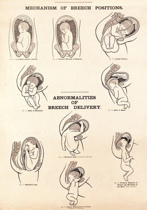 view Mechanism of breech positions and abnormalities of breech delivery. Lithograph after W. F. Victor Bonney.