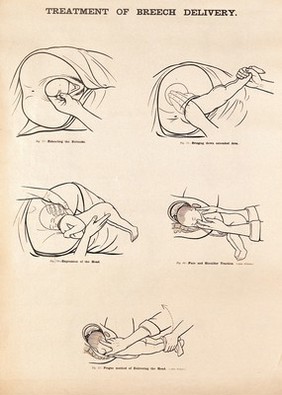 Treatment of breech delivery. Lithograph after W. F. Victor Bonney.