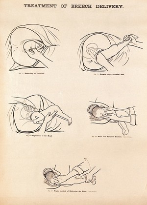 view Treatment of breech delivery. Lithograph after W. F. Victor Bonney.