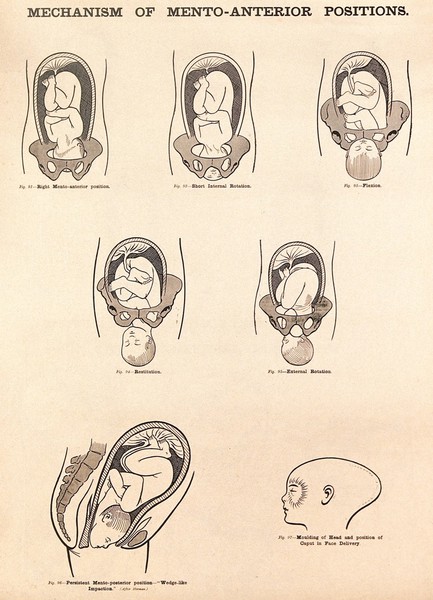 Mechanism of mento-anterior positions in childbirth. Lithograph after W. F. Victor Bonney.