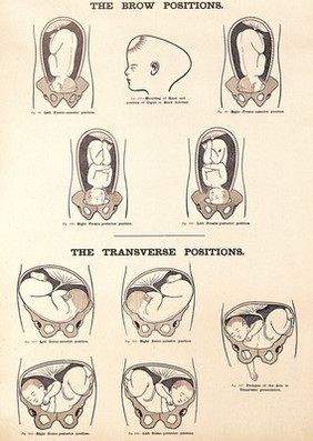 The brow positions and the transverse positions in childbirth. Lithograph after W. F. Victor Bonney.