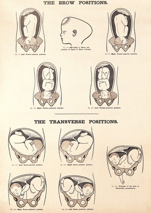 view The brow positions and the transverse positions in childbirth. Lithograph after W. F. Victor Bonney.