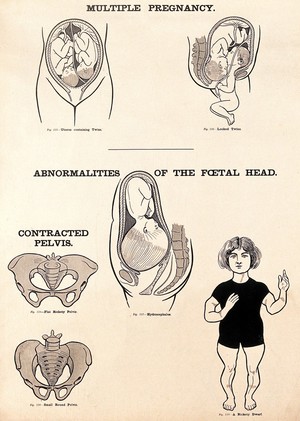 view Multiple pregnancy, abnormalities of the foetal head, and contracted pelvis in childbirth. Lithograph after W. F. Victor Bonney.