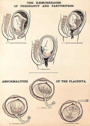 view Haemorrhages of pregnancy and parturition, and abnormalities of the placenta. Lithograph after W. F. Victor Bonney.