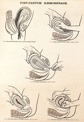 Post-partum haemorrhage. Lithograph after W. F. Victor Bonney.