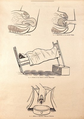 Childbirth. Lithograph after W. F. Victor Bonney.