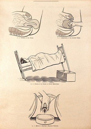 view Childbirth. Lithograph after W. F. Victor Bonney.