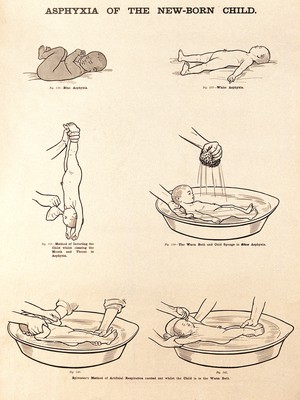 view Asphyxia of the new-born child and its treatment. Lithograph after W. F. Victor Bonney.